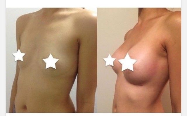 Implantatwahl vor Brustvergrößerung, 270 ml UBM high Profil, 166 cm, 52 kg - 27609