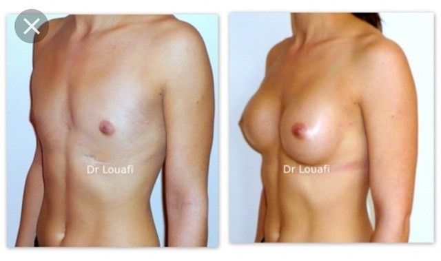 Implantatwahl vor Brustvergrößerung, 270 ml UBM high Profil, 166 cm, 52 kg - 27610