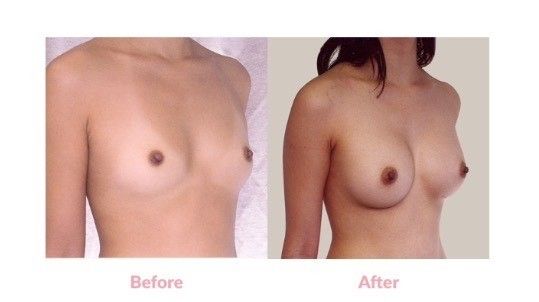 Implantatwahl vor Brustvergrößerung, 270 ml UBM high Profil, 166 cm, 52 kg - 27611