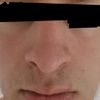 Nasenkorrektur mit 19 Jahren: Asymmetrie, große Nasenlöcher, abgesenkte Nasenspitze - 27627