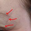 Hängende Augenbrauen und Schlupflider nach Botox gegen Migräne