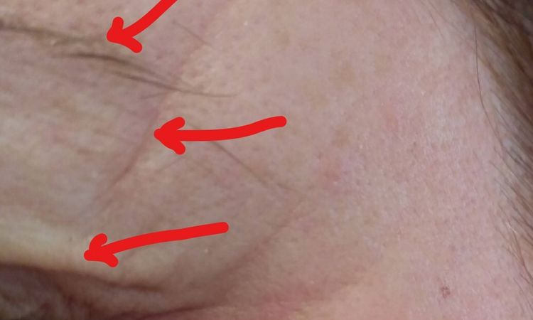 Hängende Augenbrauen und Schlupflider nach Botox gegen Migräne - 27637