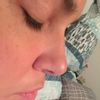 Korrektur der Nasenspitze: Latina Nase
