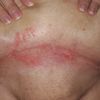 Vor Bauchstraffung: entzündete Fettschürze und Folgekostenversicherung