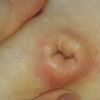 Vor Bauchstraffung: entzündete Fettschürze und Folgekostenversicherung