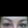 Behandlung von Tränenfurche und ersten Fältchen unter Augen - 27703