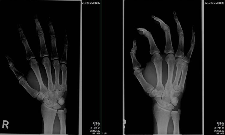 5. Mittelhandknochen disloziert - 27709