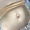 Suche Erfahrungen zur Bauchnabelkorrektur