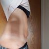 Bauchstraffung mit Avelar oder eine Minibauchdeckenstraffung?