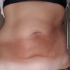 Bauchstraffung mit Avelar oder eine Minibauchdeckenstraffung?