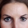 Augenbrauenanhebung oder minimalinvasive Behandlung mit Botulinumtoxin mit 36 Jahren? - 27768