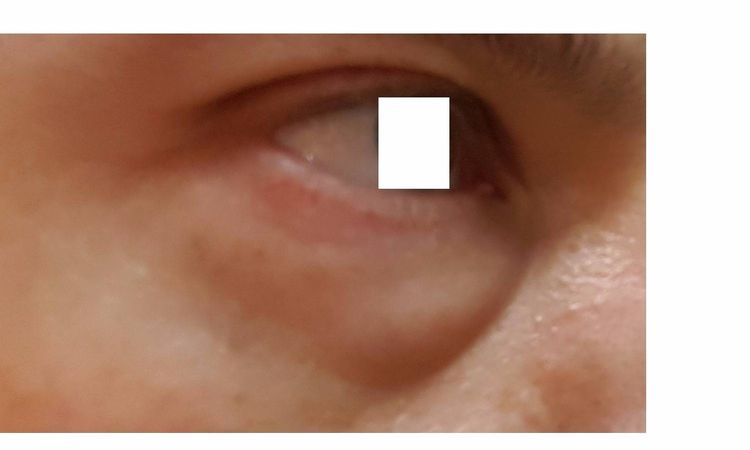 Blepharoplastik transkonjunktival in Berlin - 27769