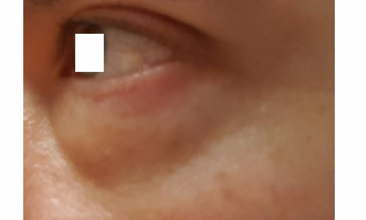 Blepharoplastik transkonjunktival in Berlin - 27770