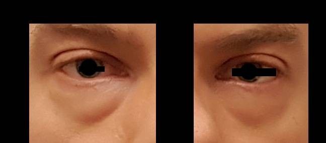 Blepharoplastik transkonjunktival in Berlin - 27771