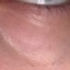 Carboxy Therapie oder Hyaluronsäure gegen Augenringe?