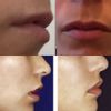 Lippenvergrößerung Raum FFM 