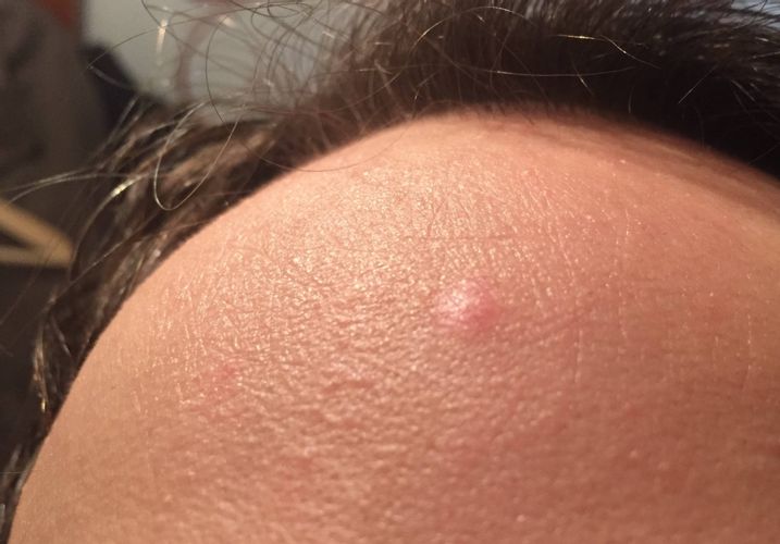 Dermabrasion-Behandlung der Narbe nach Entfernung von farblosem Nävus
