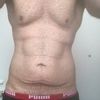 Bauchdeckenstraffung oder Fettabsaugung und Lipolaser nach Abnahme von 40 kg
