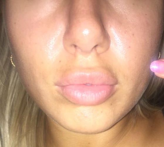 Hängende Wangen und störende Nasiobalfalte: Fadenlifting, Midfacelift oder Fettabsaugen?