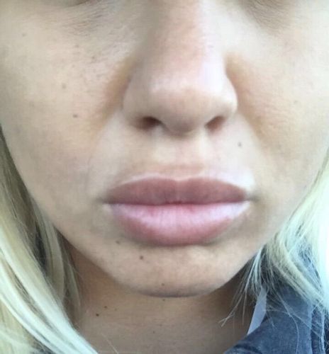 Hängende Wangen und störende Nasiobalfalte: Fadenlifting, Midfacelift oder Fettabsaugen?