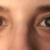 Lidkorrektur: Augenringe mit 25 Jahren