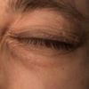 Lidkorrektur: Augenringe mit 25 Jahren