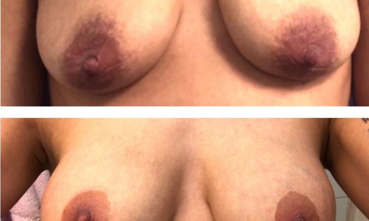 Bauchstraffung bei Schwangerschaftsstreifen oberhalb vom Bauchnabel, Verkleinerung der Warzenhöfe - 27941