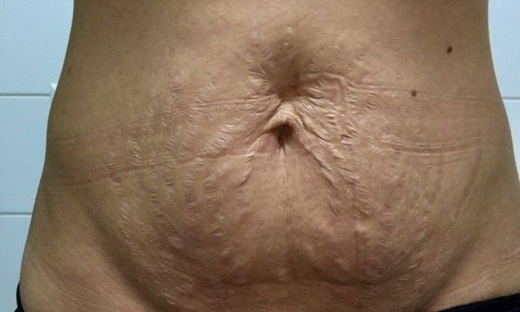Bauchstraffung bei Schwangerschaftsstreifen oberhalb vom Bauchnabel, Verkleinerung der Warzenhöfe - 27942