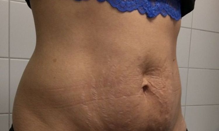 Bauchstraffung bei Schwangerschaftsstreifen oberhalb vom Bauchnabel, Verkleinerung der Warzenhöfe - 27943