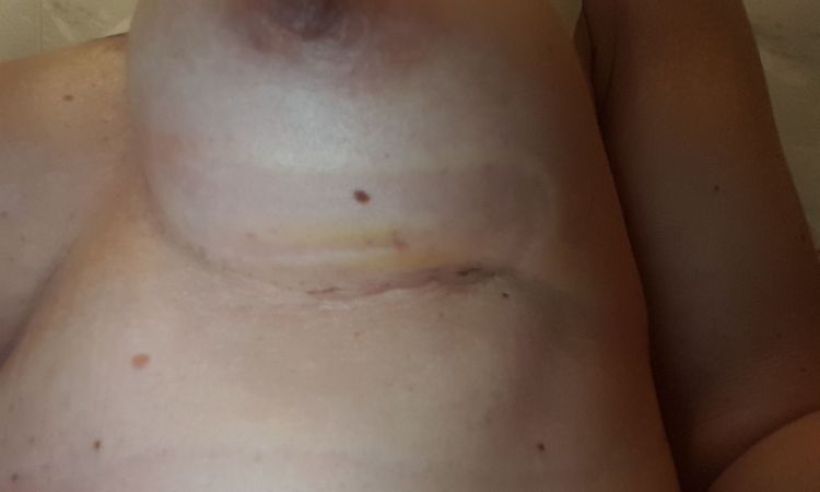 Schnelle Wundheilung nach Brustvergrößerung - 27959