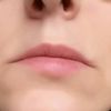 Lippenkorrektur bei asymmetrischen Lippen - 27996
