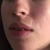 Korrektur der Narben am Lippenrot, Nasenflügel und an linker Wange - 28043