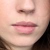 Korrektur der Narben am Lippenrot, Nasenflügel und an linker Wange - 28044