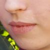 Korrektur der Narben am Lippenrot, Nasenflügel und an linker Wange - 28045