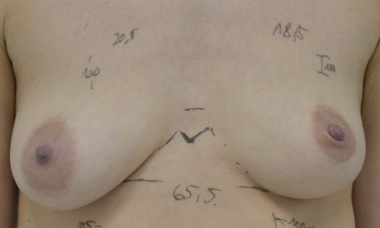 Asymmetrie-Ausgleich bei Brustvergrößerung durch Straffung, 155 cm, 44 kg - 28065