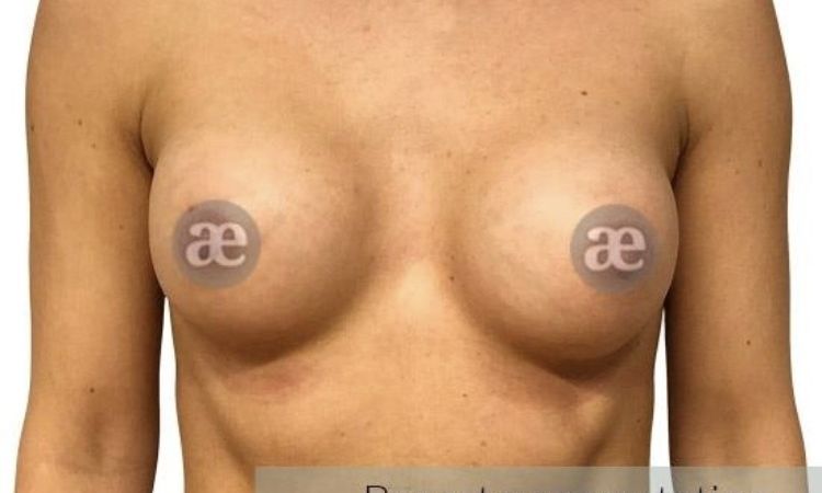 Asymmetrie-Ausgleich bei Brustvergrößerung durch Straffung, 155 cm, 44 kg - 28066