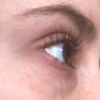Unterlidstraffung bei dunklen Augenringen mit 28 Jahren - 28092