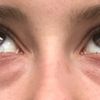 Unterlidstraffung bei dunklen Augenringen mit 28 Jahren - 28093