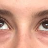 Unterlidstraffung bei dunklen Augenringen mit 28 Jahren - 28094