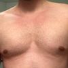 Gynäkomastie: Fett unter der Brust beim Mann?