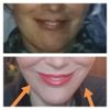 Behandlung von hohem Mundwinkel und Falte zwischen Nase und Oberlippe - 28129