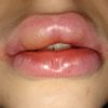 Wiederholte Lippenvergrößerung mit Hyaluronsäure trotz Reaktion vor 1 Jahr - 28167