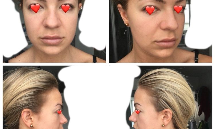 Buccal fat removal, Facelift, Fadenlift oder Kiefer-OP? - 28169