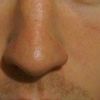 Therapiemöglichkeiten: große Poren und Falte am Auge - 28183