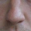 Therapiemöglichkeiten: große Poren und Falte am Auge - 28184
