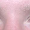 Botulinumtoxin nach Oberlidstraffung: Krähenfüße und Augenbrauen anheben