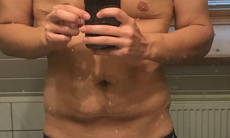 Bauchdeckenstraffung nach Abnahme von 43 kg? - 28194