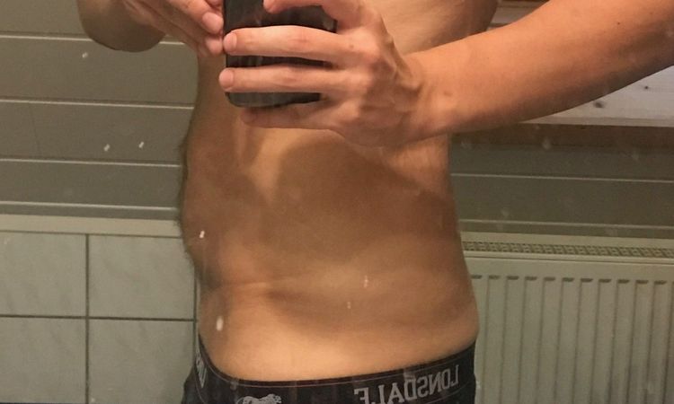 Bauchdeckenstraffung nach Abnahme von 43 kg? - 28195