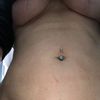 Suche Spezialisten für Korrektur der Unebenheiten nach Lipo am Bauch