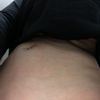 Suche Spezialisten für Korrektur der Unebenheiten nach Lipo am Bauch